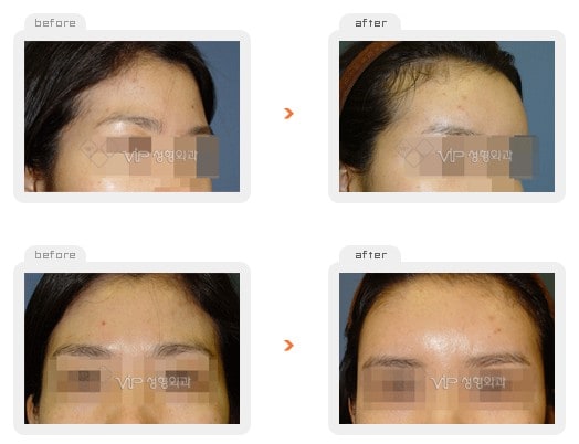 	Stem Cell Fat Graft	 - Fat graft - forehead & temple