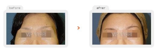 Stem Cell Fat Graft - Fat graft - forehead & temple