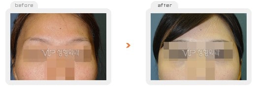 Stem Cell Fat Graft - Fat graft - forehead & temple