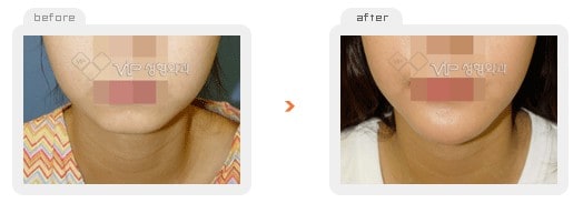 Stem Cell Fat Graft - Fat graft - front chin