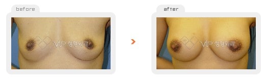 	Breast Surgery	 - Breast augmentation