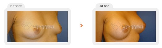 	Breast Surgery	 - Breast augmentation