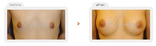 Breast Surgery - Breast augmentation