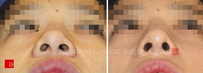 	Harmony-Rhinoplasty, Protruded Mouth Correction Rhinoplasty, Rib cartilage Rhinoplasty, Revision Rhinoplasty, Septal Deviation	 - Septal deviation with mid face retrusion