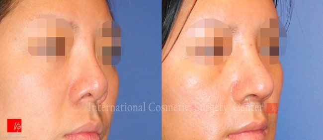 	Nose Surgery, Revision Rhinoplasty, Each Cases Nose	 - Remove foreign implant & autologous rhinoplasty