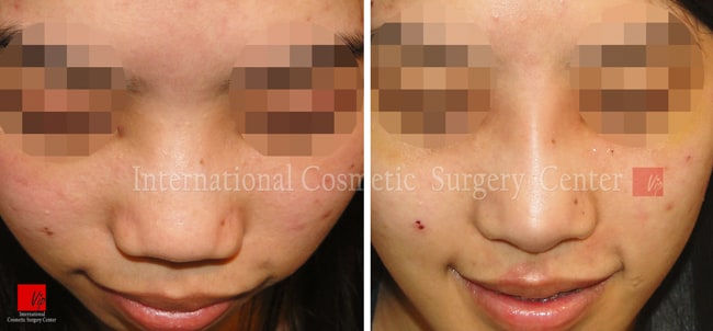 	Nose Surgery, Harmony-Rhinoplasty, Rib cartilage Rhinoplasty	 - Correction of protruded mouth with Harmony rhinoplasty