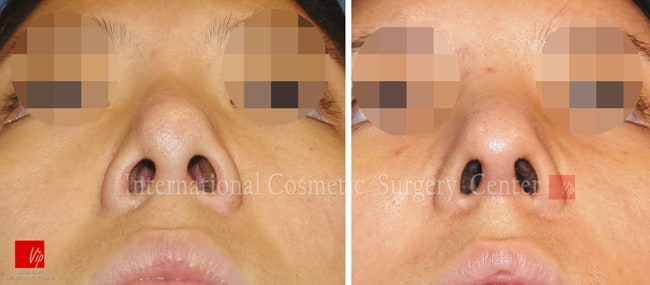 	Nose Surgery, Revision Rhinoplasty, Each Cases Nose	 - Remove foreign implant & autologous rhinoplasty