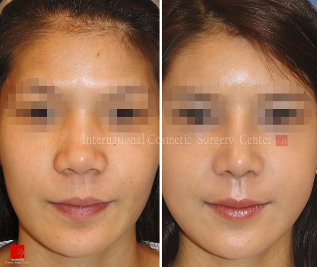 	Nose Surgery, Harmony-Rhinoplasty, Each Cases Nose	 - Harmony face surgery