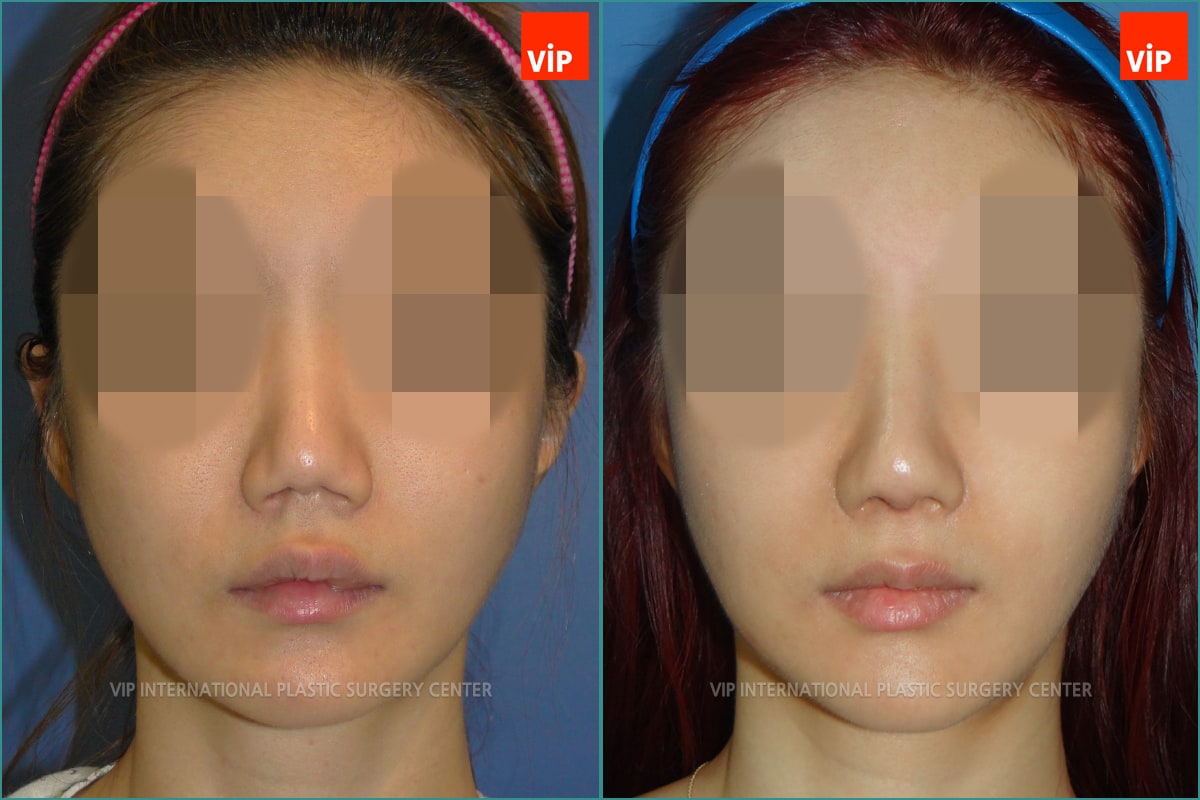 	Nose Surgery, Rib cartilage Rhinoplasty, Contracted Nose, Each Cases Nose	 - Rib cartilage Rhinoplasty