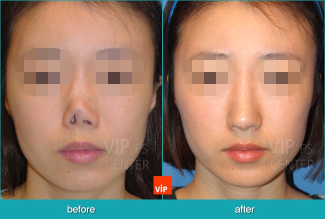 	Nose Surgery, Rib cartilage Rhinoplasty, Contracted Nose, Revision Rhinoplasty, Each Cases Nose	 - Reconstructed nose by rib cartilage rhinoplasty