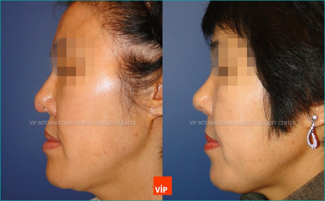 	Nose Surgery, Harmony-Rhinoplasty, Rib cartilage Rhinoplasty, Contracted Nose, Revision Rhinoplasty	 - Harmony Rhinoplasty