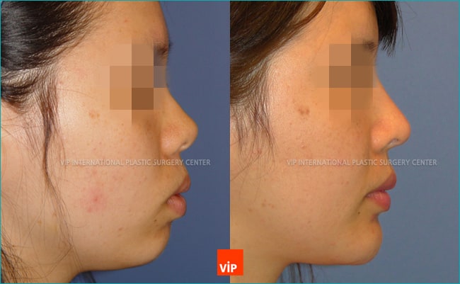 	Nose Surgery, Harmony-Rhinoplasty, Protruded Mouth Correction Rhinoplasty, Each Cases Nose, Septal Deviation	 - Protruded Mouth Correction by Rhinoplasty