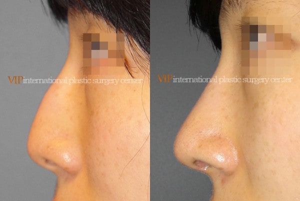 Nose Surgery - Nose bridge correction