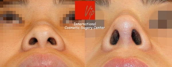 	Nose Surgery, Harmony-Rhinoplasty, Protruded Mouth Correction Rhinoplasty, Rib cartilage Rhinoplasty, Each Cases Nose	 - VIP Harmony rhinoplasty (correction of mid face retrusion & protruded mouth)
