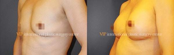 Breast Surgery - Breast surgery