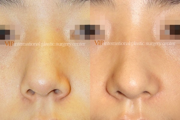 Nose Surgery - Nose bridge correction