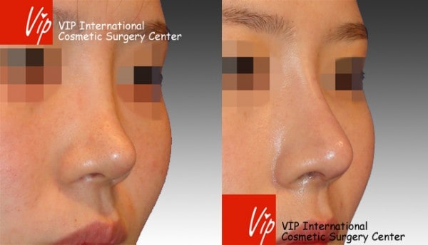 	Nose Surgery, Rib cartilage Rhinoplasty, Revision Rhinoplasty	 - Silicone nose revision - Rib cartilage rhinoplasty