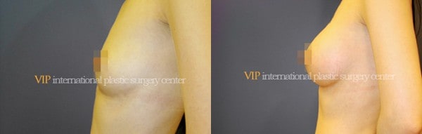 Breast Surgery - Breast surgery