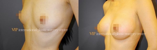 Breast Surgery - Breast surgery