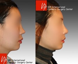 Silicone nose revision - Rib cartilage rhinoplasty