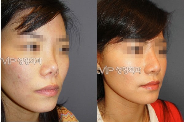 	Rib cartilage Rhinoplasty, Contracted Nose, Revision Rhinoplasty	 - Upturned nose due to silicone contraction - Revision with Rib cartilage