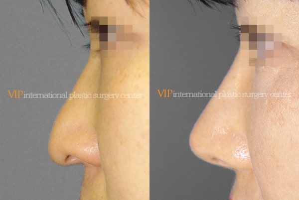 Nose Surgery - Long nose with Depressed columella