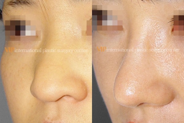 Nose Surgery - Long nose with Depressed columella