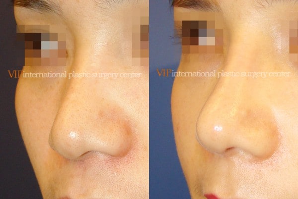 Nose Surgery - Rhinoplasty