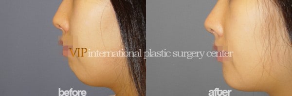 Facial Bone Surgery - Genioplasty