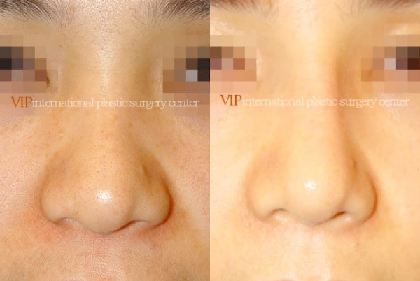 Nose Surgery - Rhinoplasty