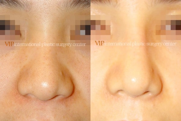 Nose Surgery - Rhinoplasty