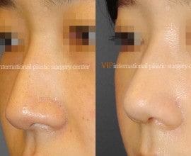 Rhinoplasty