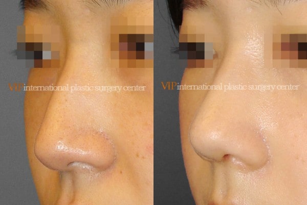 Nose Surgery - Rhinoplasty