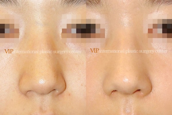 Nose Surgery - Rhinoplasty