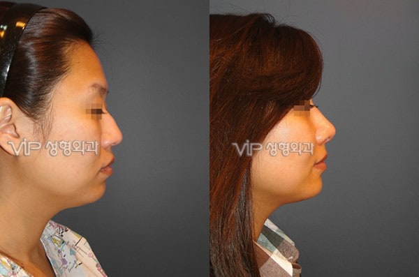 	Nose Surgery, Rib cartilage Rhinoplasty, Revision Rhinoplasty	 - Septal cartilage rhinoplasty