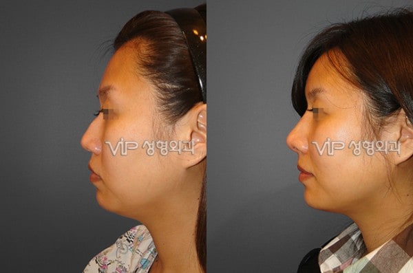 	Nose Surgery, Rib cartilage Rhinoplasty, Revision Rhinoplasty	 - Septal cartilage rhinoplasty