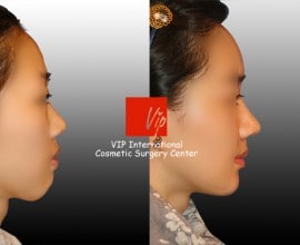 Harmony rhinoplasty