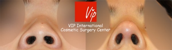 	Nose Surgery, Rib cartilage Rhinoplasty, Each Cases Nose	 - Short & Flat nose - Rib cartilage rhinoplasty