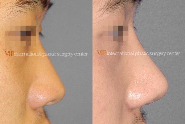 Nose Surgery - Rhinoplasty