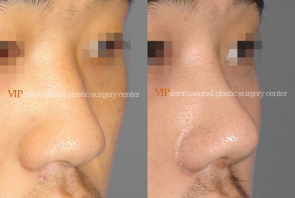 Nose Surgery - Rhinoplasty