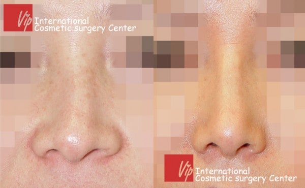 	Nose Surgery, Rib cartilage Rhinoplasty, Revision Rhinoplasty	 - Deviated nose correction