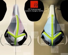 Smart rhinoplasty - Septal deviation correction + Cosmetic s…