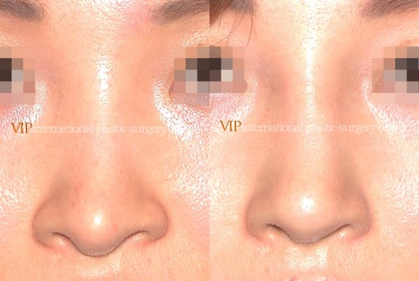 Nose Surgery - Revision rhinoplasty - Silicone showing nose