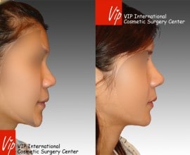 Septal cartilage rhinoplasty - Wide nasal bone reduction & A…