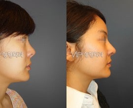 Revision of short nose - Rib cartilage rhinoplasty