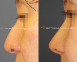 Rhinoplasty