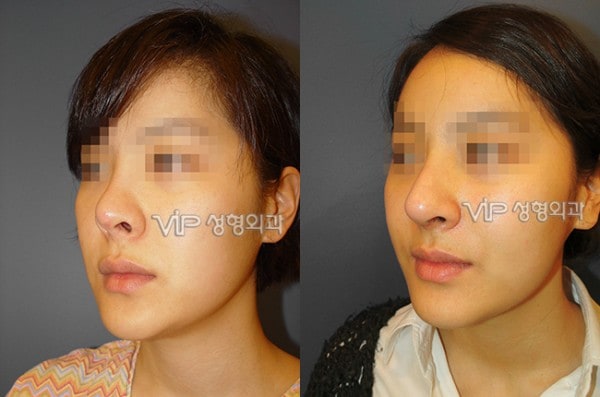 	Nose Surgery, Rib cartilage Rhinoplasty	 - Revision of short nose - Rib cartilage rhinoplasty