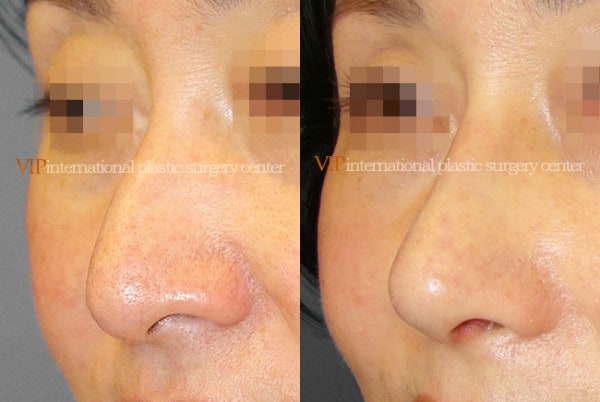 Nose Surgery - Rhinoplasty