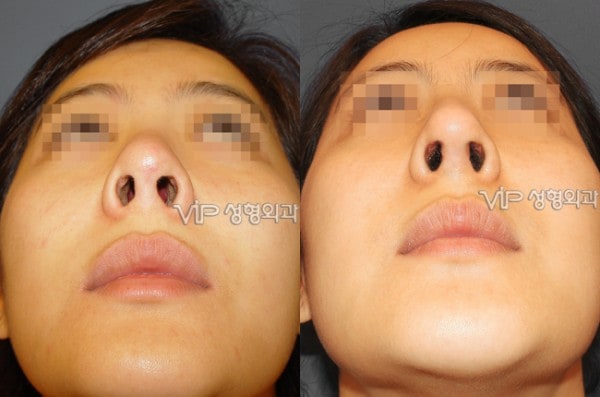 	Nose Surgery, Rib cartilage Rhinoplasty	 - Revision of short nose - Rib cartilage rhinoplasty