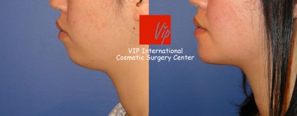 Facial Bone Surgery - Genioplasty